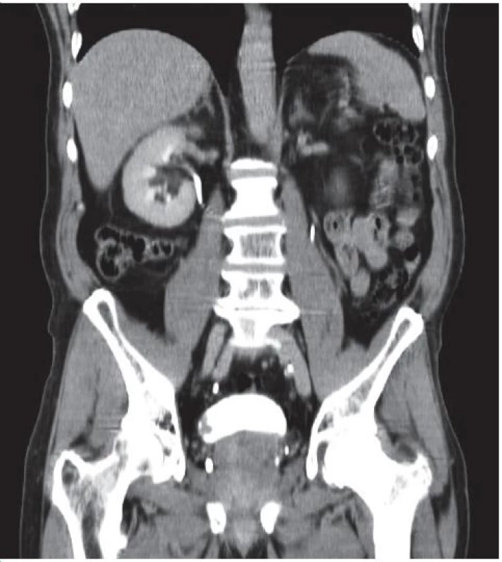 Tumor močového měchýře, CT snímek, vylučovací fáze, koronární scan 
Fig. 3. Bladder tumor, CT image, excretory phase, coronar scan
