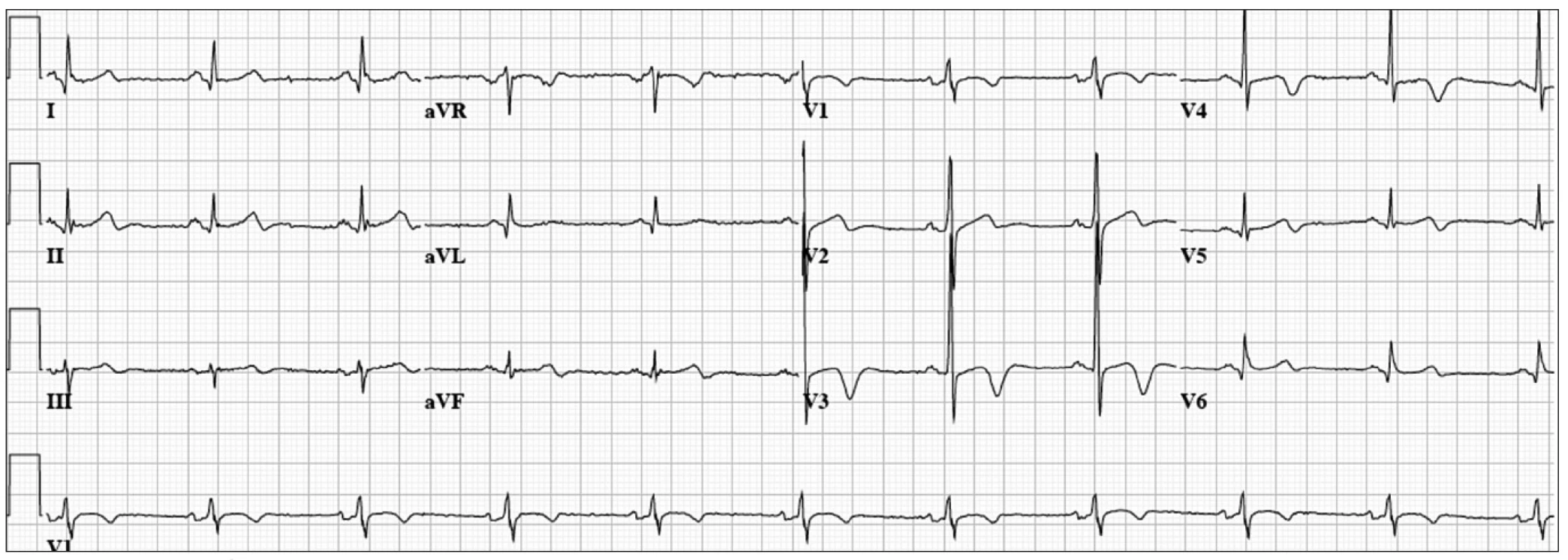 53 year old man with exertional chest pain.