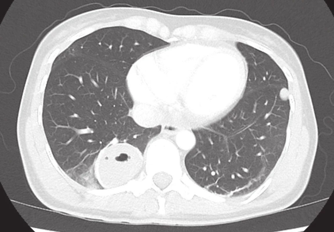 Traumatická plicní pseudocysta v pravém dolním laloku
Fig. 2: Traumatic pulmonary pseudocyst in the right lower lobe