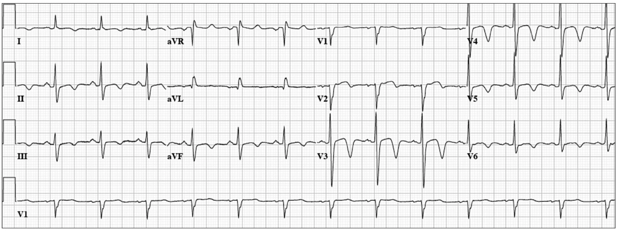 52 year-old woman with acute chest pain and dyspnea.