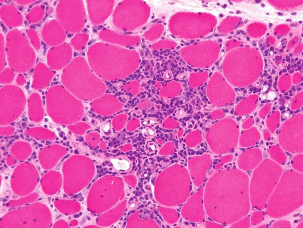 Endomyziální infiltrace lymfocyty, částečně podobná intersticiální infiltraci při polymyozitidě. Barvení izopentanem zmraženého řezu hematoxylinem a eozinem, originální zvětšení 200x.