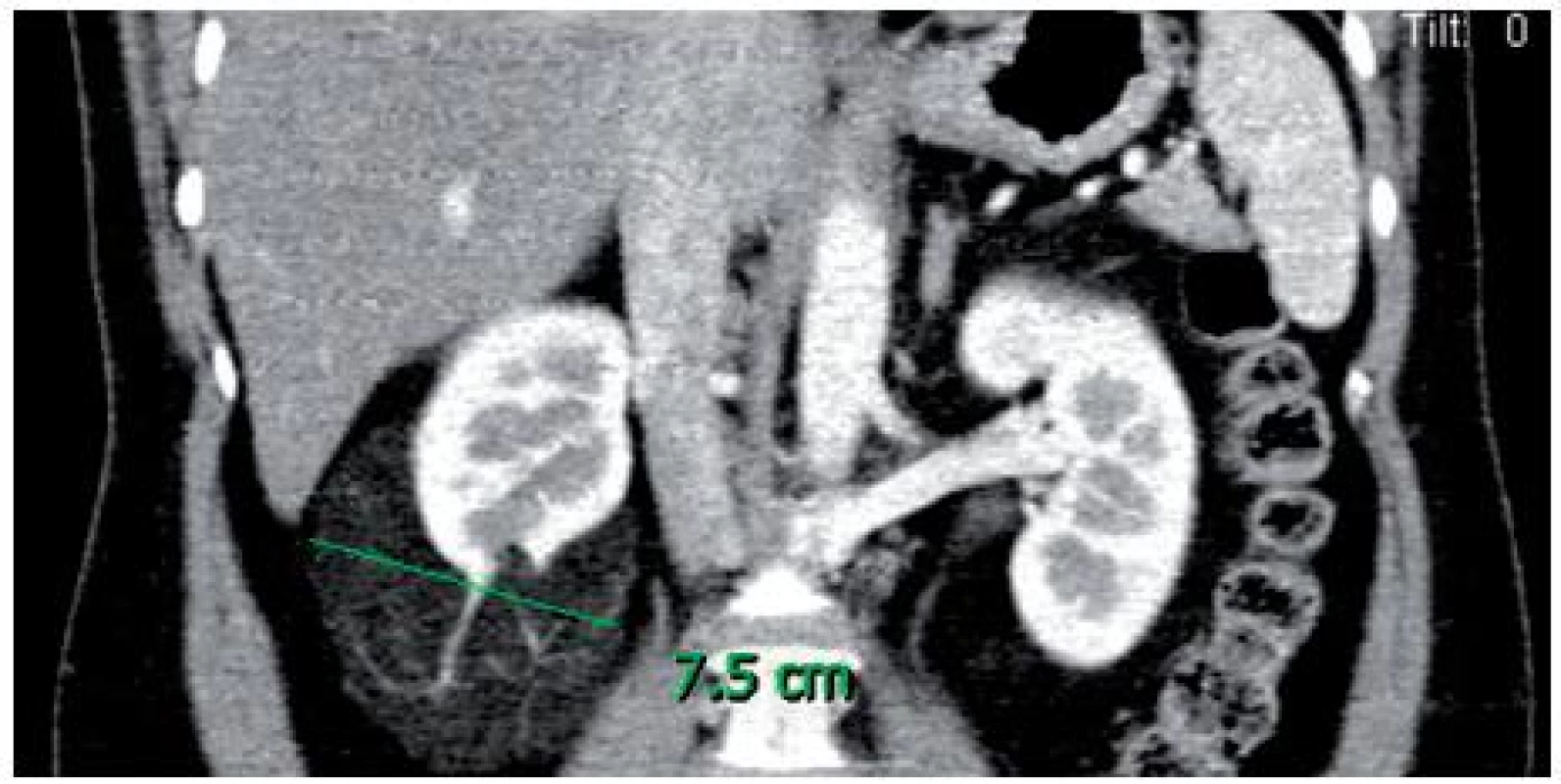 CT snímek tumoru
Fig. 1. CT of tumour
