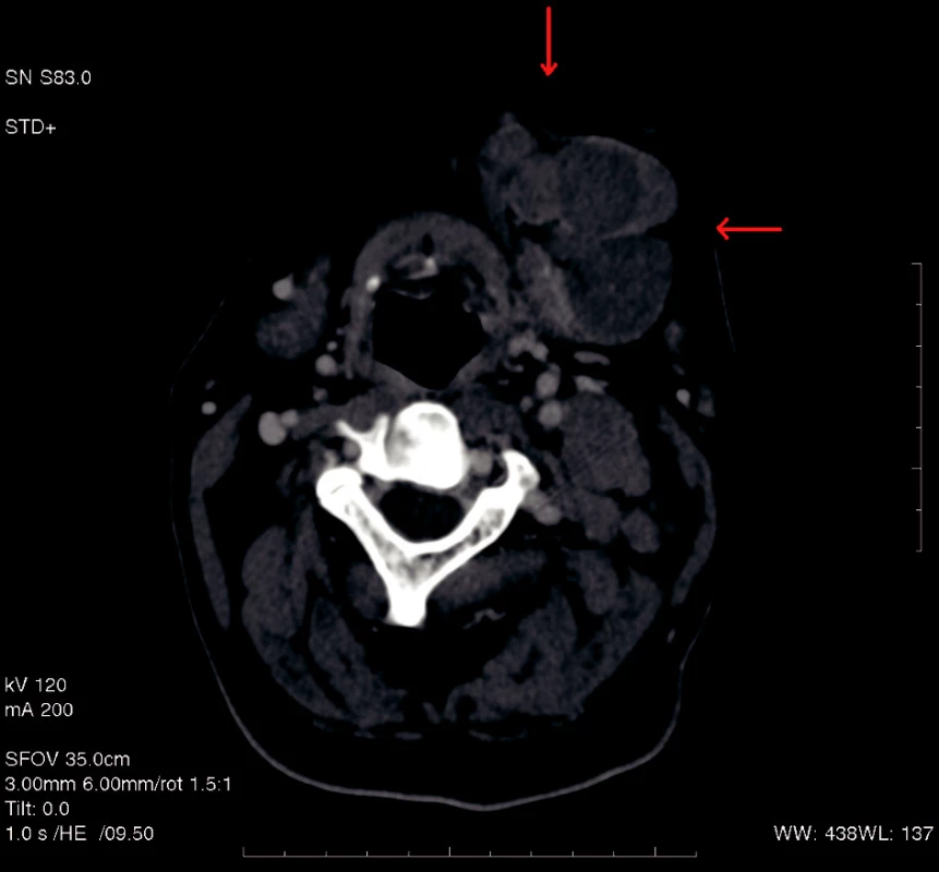 Tomogram ukazující nádorový stín naléhající na laterální okraj mandibuly vpravo s deformací okolních měkkých tkání.