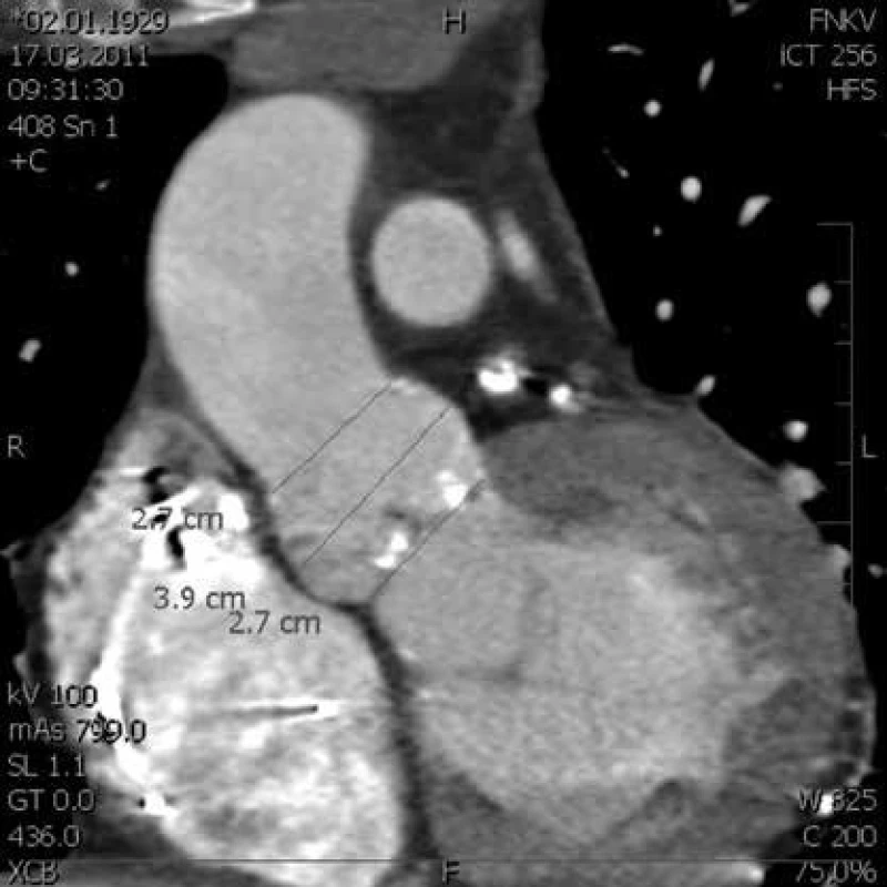 CT vyšetření aortální chlopně a ascendentní aorty před plánovanou katetrizační náhradou aortální chlopně