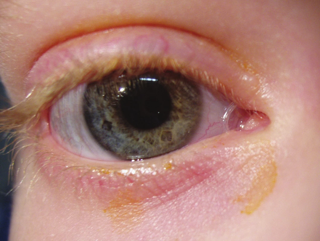 Bikanalikulární intubace pravého oka, silikonová kanyla mezi slznými body