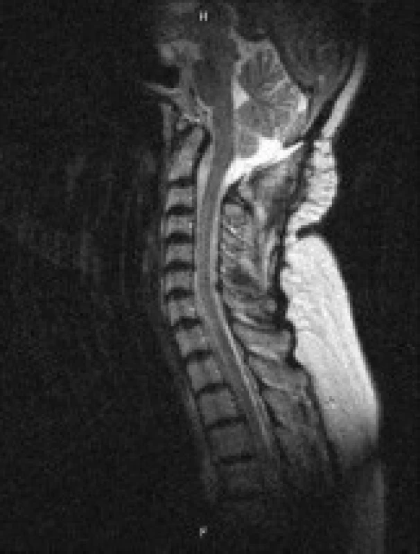 kontrolní MRI vyšetření s odstupem 10 měsíců od operace.