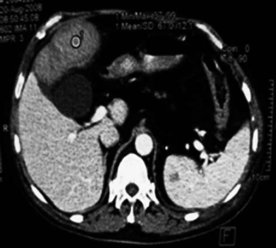 CT obraz tumoru hepatálnej flexúry.