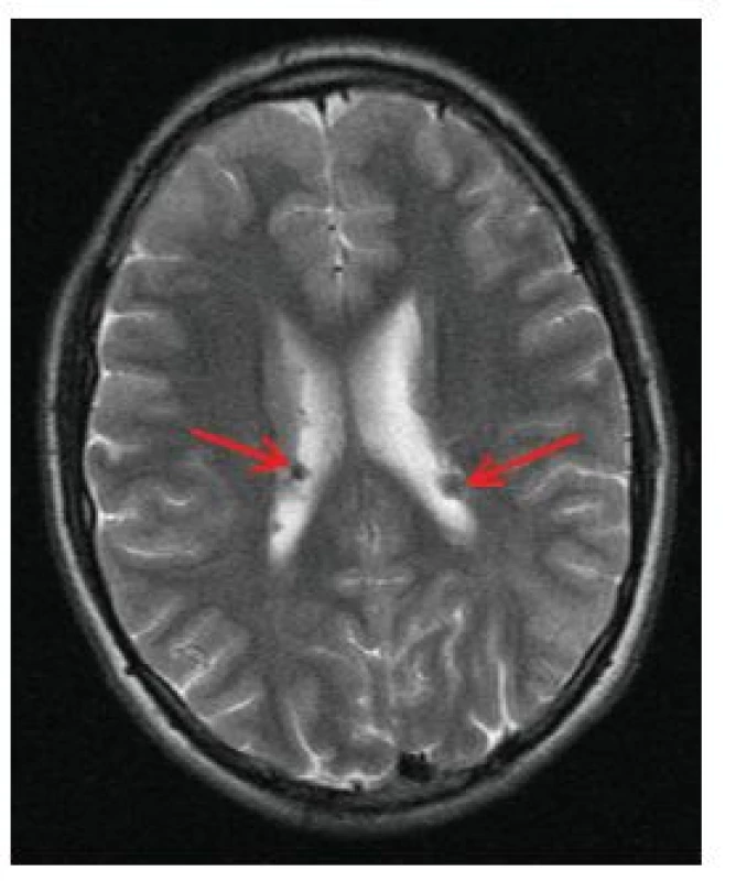 Vícečetné subependymální noduly (SEN) v oblasti postranních komor mozku oboustranně (šipky) na MR vyšetření mozku v T2 vážených obrazech u 17letého chlapce