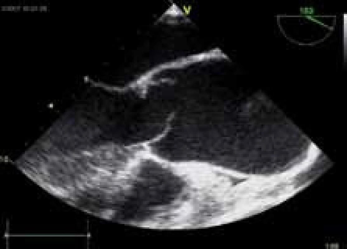 Morfologické změny aortální chlopně a ascendentní aorty – asymetrie cípů u bikuspidální aortální chlopně, dilatace ascendentní aorty.