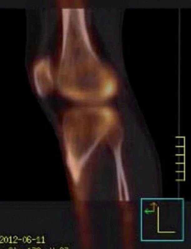 Dynamická scintigrafie (SPECT) pravého kolenního kloubu. Vyšší aktivita v kondylech femuru i tibie (červen roku 2012).