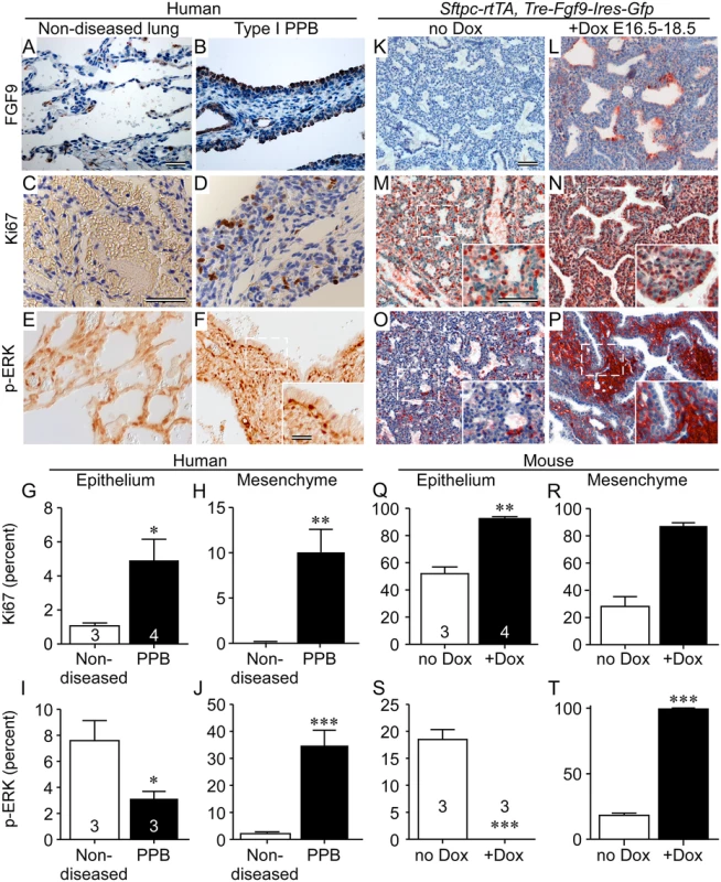 FGF9 overexpression in Type I PPB phenocopies ectopically expressed FGF9 in mouse lung epithelium.
