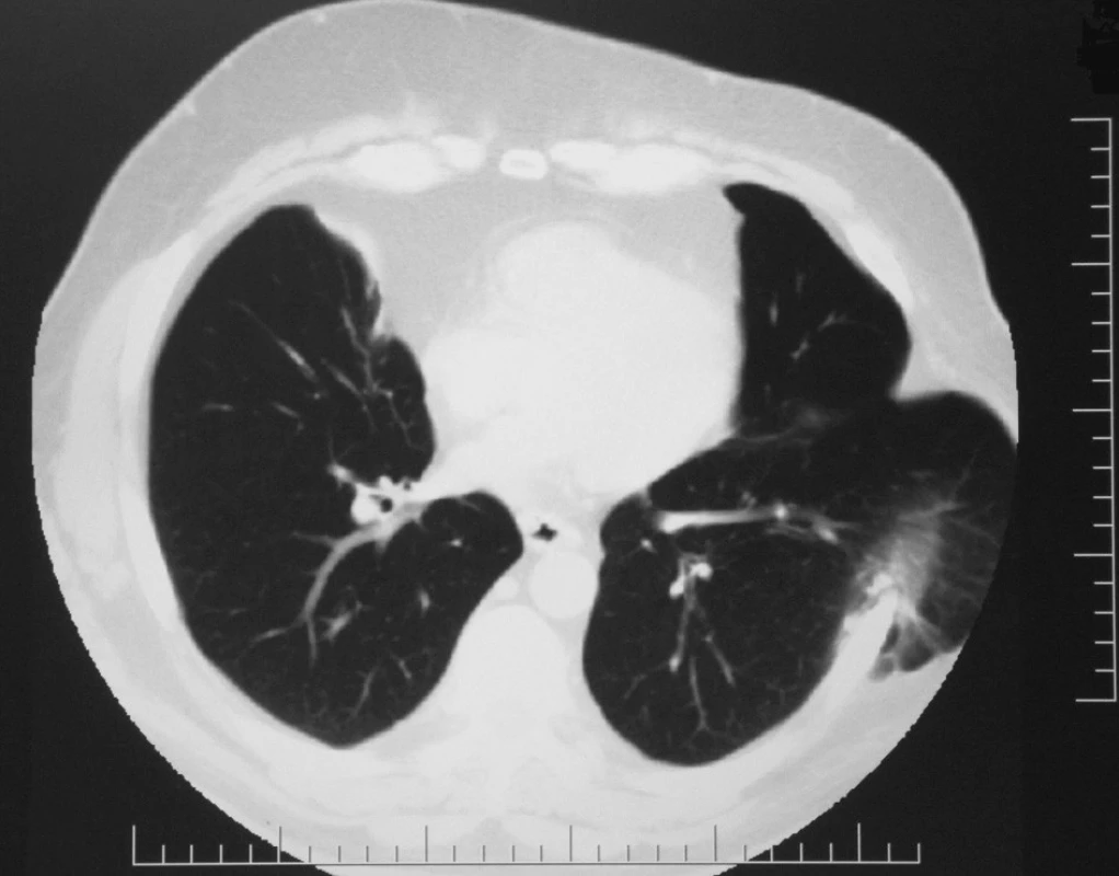Axiálne zobrazenie hernie pľúc v VI. medzirebrí vľavo na CT