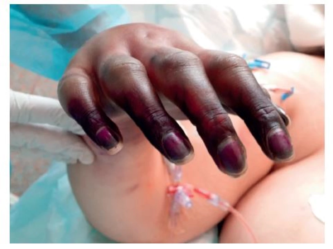 Progrese akrocyanózy do suché gangraeny prstů