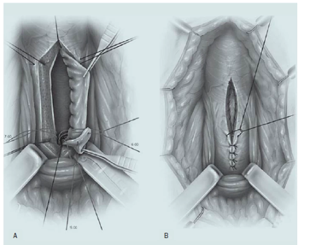 Uretroplastika technikou ventrálního onlay graftu. A – Podélné otevření bulbární části močové trubice podél ventrálního povrchu, přičemž je štěp ze sliznice dutiny ústní suturou fixován k původní uretrální ploténce. B – Spongiózní tkáň je uzavřena přes tento štěp.