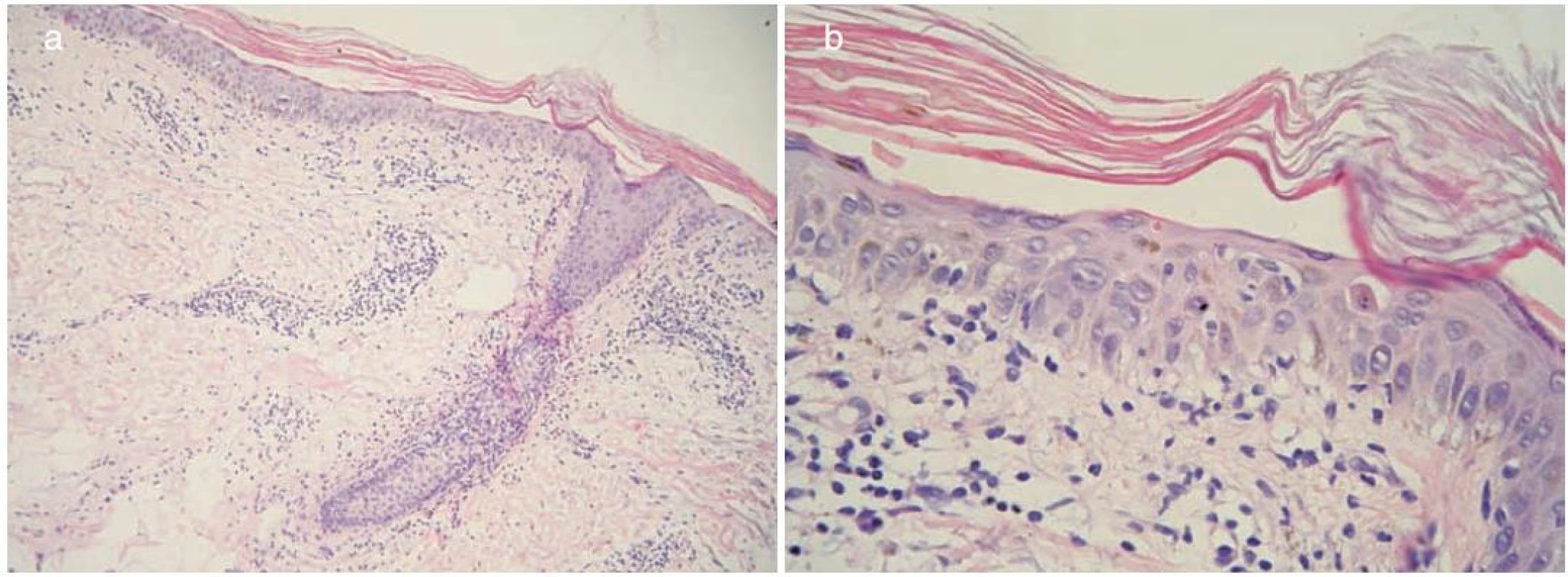 Histopatologický obraz a) a b)
