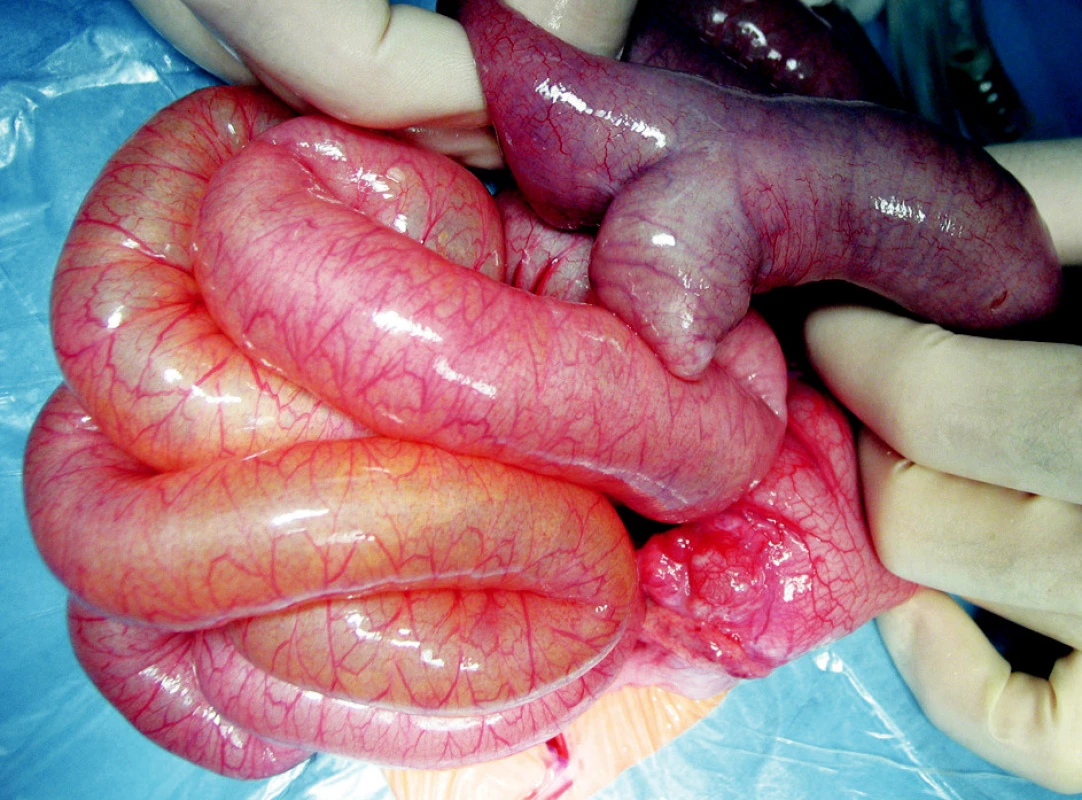 Meckelov divertikul, dilatované kľučky tenkého čreva
Fig. 4. Meckel’s diverticle, dilated small intestinal loops