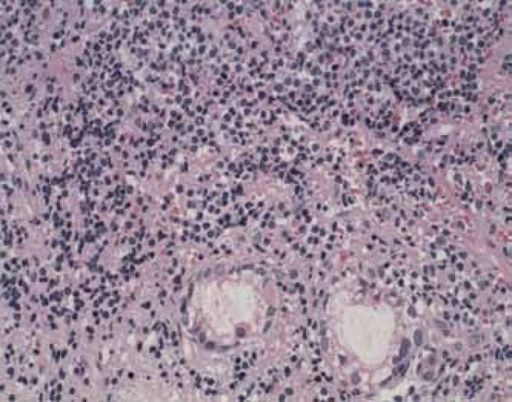 H &amp; E, 400× cytologický obraz po KHB (lymfoidní infiltrace B buněk). Exprese CD 20, LCA, bcl2, CD 3,5.