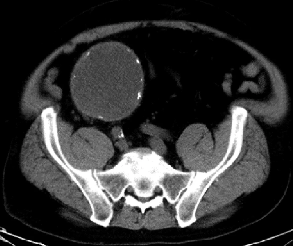 CT vyšetření – transverzální řez
Fig. 1: CT examination – transversal scan