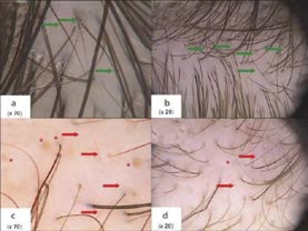 Trichoskopie frontální krajiny u androgenní alopecie