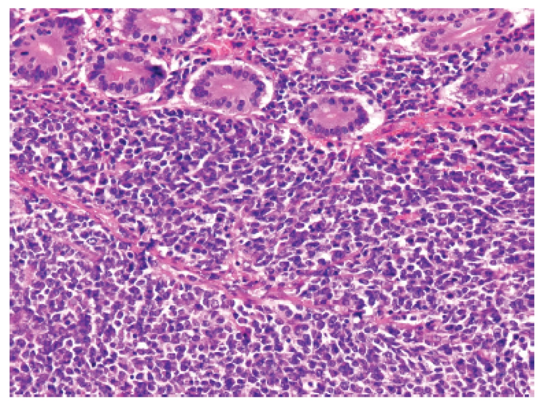 Kazuistika &lt;b&gt;1&lt;/b&gt;. Solidní primitivní nediferencovaný tumor z oválných „modrých“ buněk prostupující stěnu tenkého střeva těsně pod sliznici (HE, 200x).