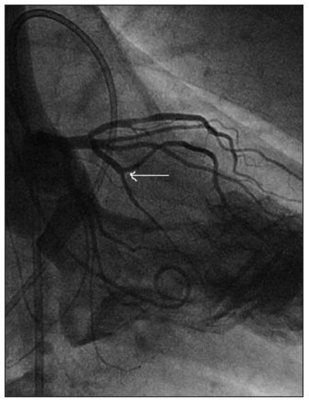 Nemocný s hypertrofickou obstrukční kardiomyopatií, při koronarografii se dobře plní velká septální větev