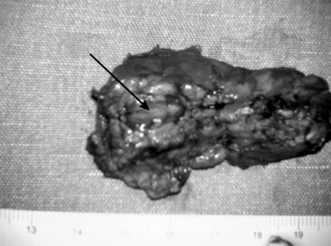 Resekovaná časť pankreasu.
Fig. 3. Resected part of pancreas.