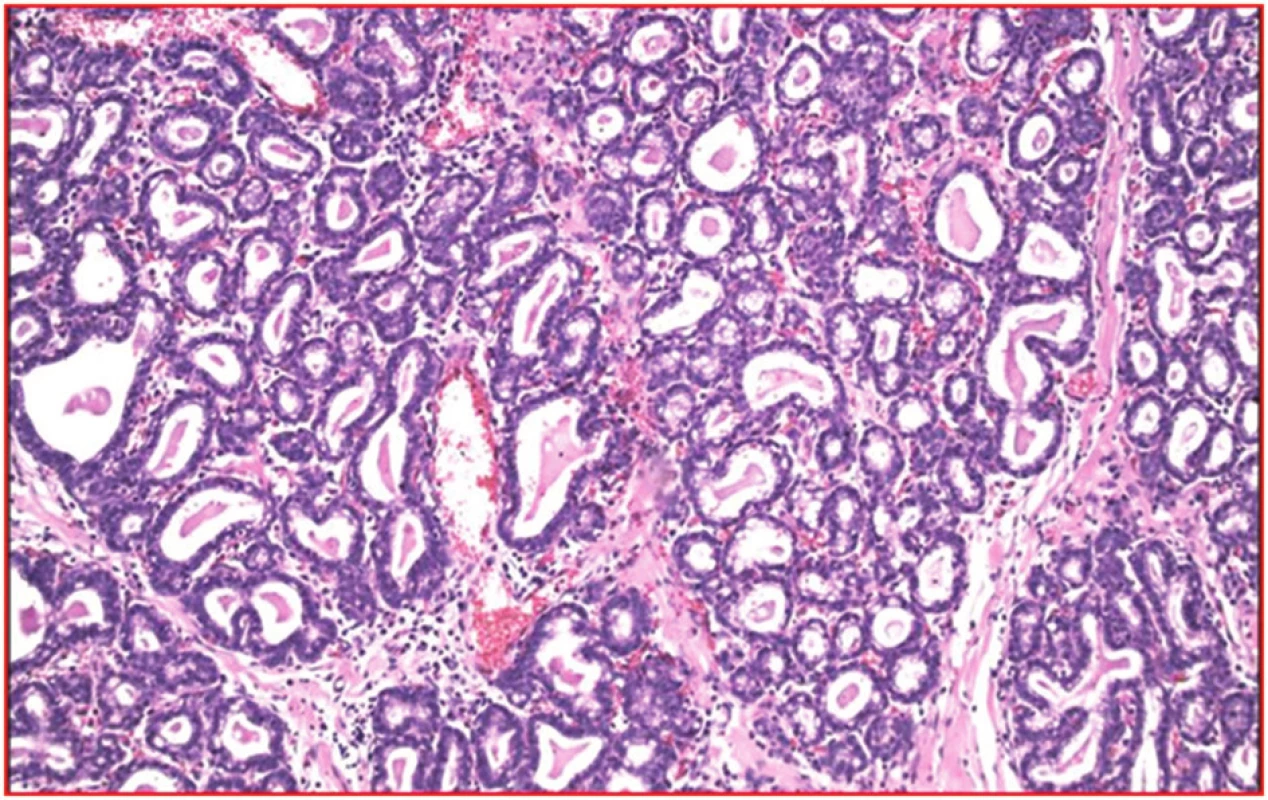 Dilatované vývody a atrofické lobuly heterotopickej mliečnej žľazy vo výrazne kolagenizovanej stróme (hematoxylín, eozín; 100x)
Fig. 6: Dilated ducts and atrophic lobules of heterotopic mammary gland in significantly collagenized stroma (hematoxylin, eosin; 100x)