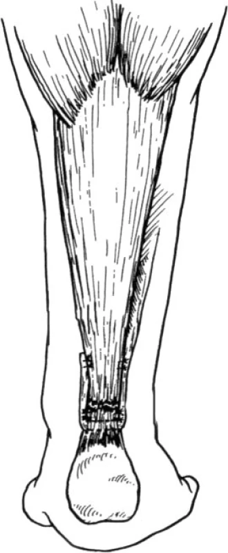 Modifikace dle
Turco a Spinella [14] (Volně podle Turco, V.J., Spinella, A.J. Achilles tendon rupture – peroneus brevis transfer. Foot and Ankle. 7, 253–259, 1987. )