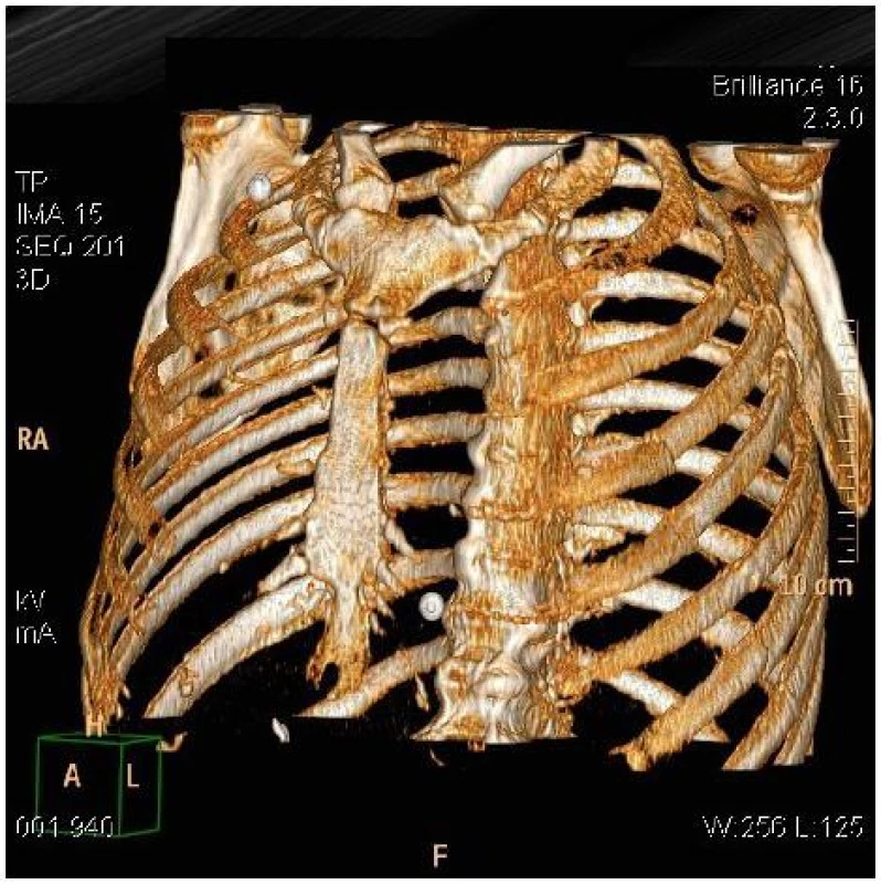 3 D rekonstrukce hrudního koše s popisovanou dvířkovou zlomeninou