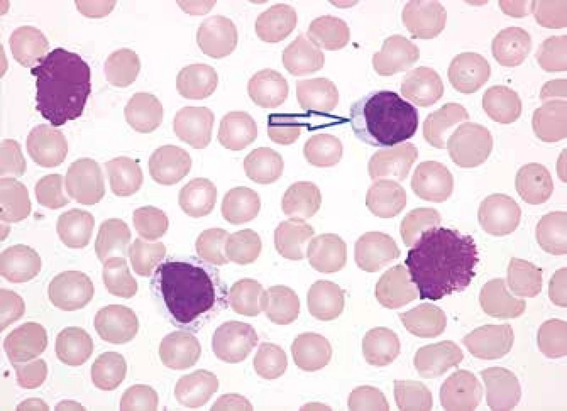 Atypická CLL, pleomorfní varianta s vakuolizovanými lymfocyty (malý zralý lymfocyt
s cytoplazmatickou vakuolou – označena šipkou), případ se odlišoval od typické CLL většinovou přítomností vakuolizovaných lymfocytů