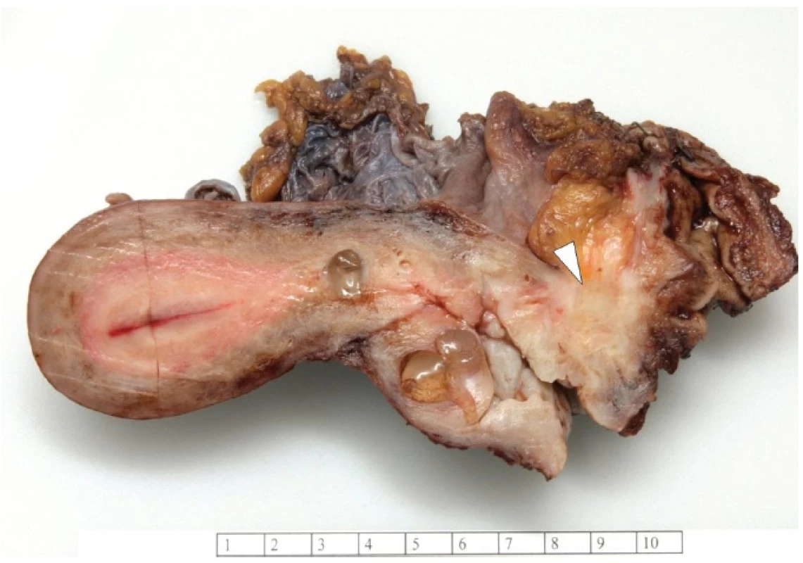 Tumor of the posterior wall of vagina.