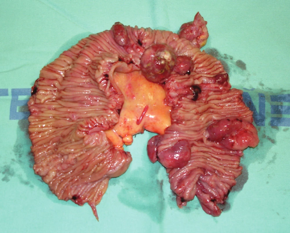 Resekát jejuna s infiltrací lymfomem
Fig. 8. Jejunal resecate with lymphoma infiltration
