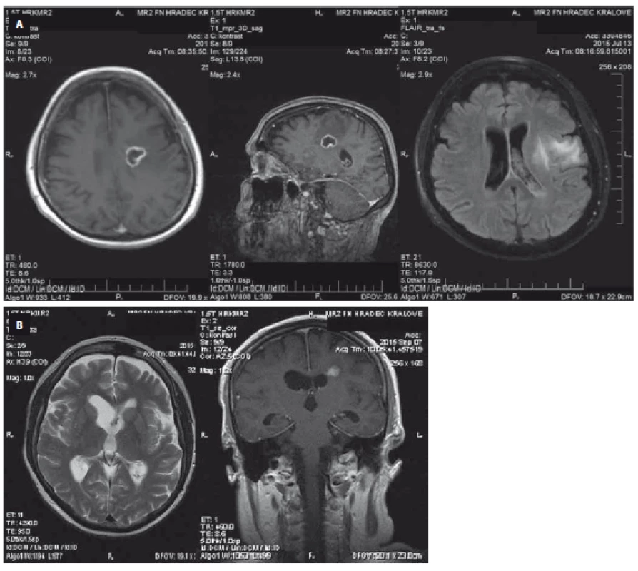 MRI scan of the brain of patient 1 on day 10 showing the brain abscess and ventriculitis with pathological content in the left lateral ventricle appearing as small abscesses (A) and day 62 showing a disappearance of the liquid in the site of the former abscess and signs of scarring in the surrounding tissue (B).
Obr. 1. MR vyšetření mozku pacientky číslo 1 ukazuje 6. den hospitalizace mozkový absces a ventrikulitis s patologickým obsahem v levé postranní komoře ve formě malých abscesů (A) a 62. den vymizení tekutiny v místě původního abscesu se známkami jizvení v okolní tkáni (B).