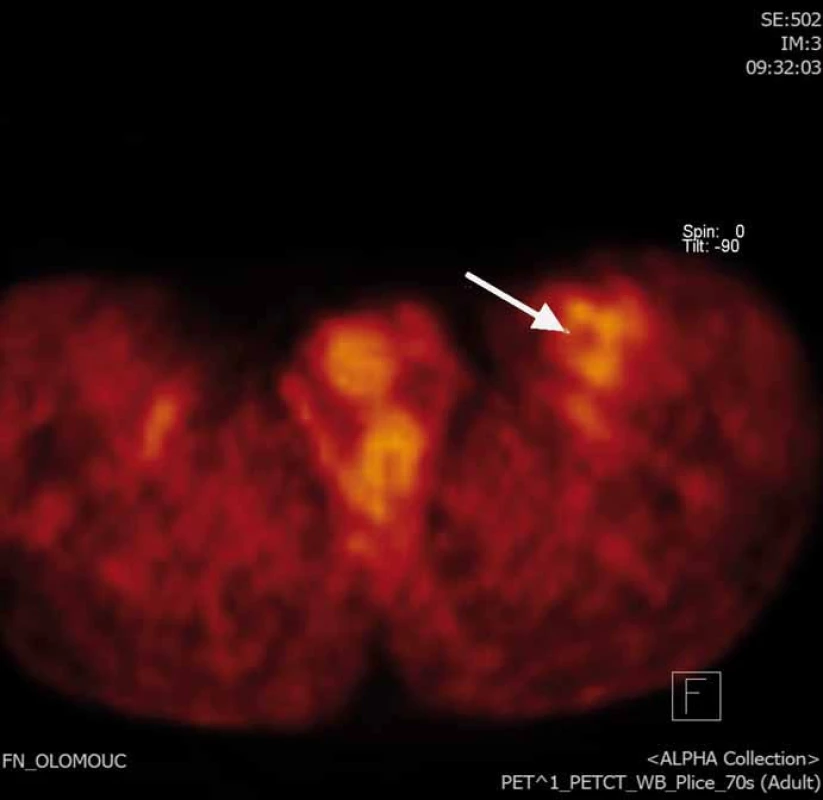 PET/CT FDG obraz rezidua nádoru v resekční dutině.