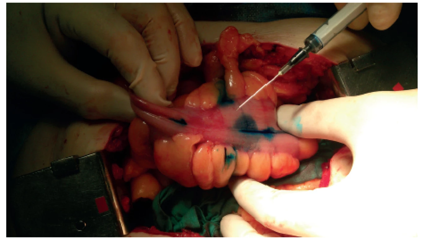 Nástřik tumoru peritumorálně subserózně do čtyř kvadrantů
Fig. 1: Patentblue dye injection peritumorously subserosally