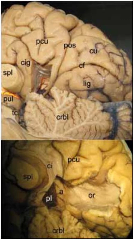 Laboratorní disekce mediálního aspektu hemisféry.
Obr. 1a) Pohled na zadní mediální aspekt mozkové hemisféry s přístupem do atria komory prekuneálním gyrem.
tc – tectum, crbl – cerebellum, lig – gyrus lingualis, cf – fissura calcarina, cu – cuneus, pos – sulcus parieto-occipitalis, pcu – precuneus, cig – gyrus cinguli, spl – splenium, pul – pulvinar thalami, šipka označuje pro přístup důležitou hranici: parieto-okcipitální sulkus
Obr. 1b) Pohled do atria komory po subkortikální preparaci drah, optická radiace běží na laterální straně komory ve stratum saggitale.
pl – plexus, a – atrium, ci – cingulum, or – radiatio optica