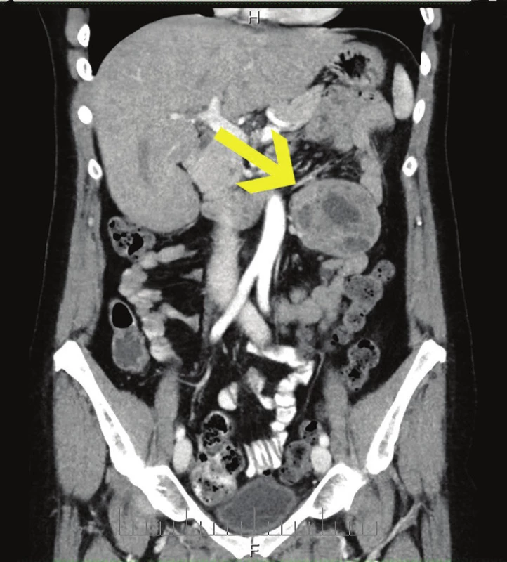 CT s tumorem v levém mezogastriu, koronární řez
Fig. 1: CT scan with tumour in the left mesogastrium, coronary section