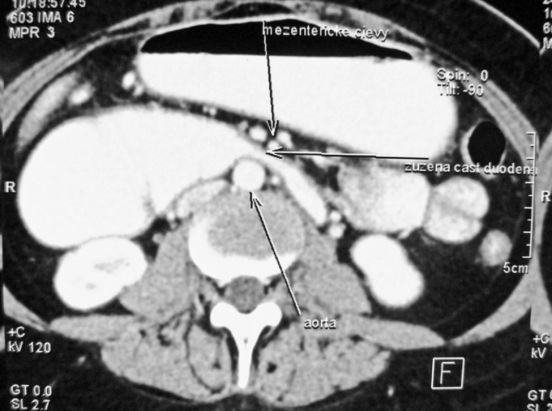 CT scan v axialnej rovine. Zobrazuje kompresiu     duodéna medzi AA a AMS
Fig. 3. CT scan, axial plane. Compression of the duodenum between the AA and SMA (AMS) is apparent
