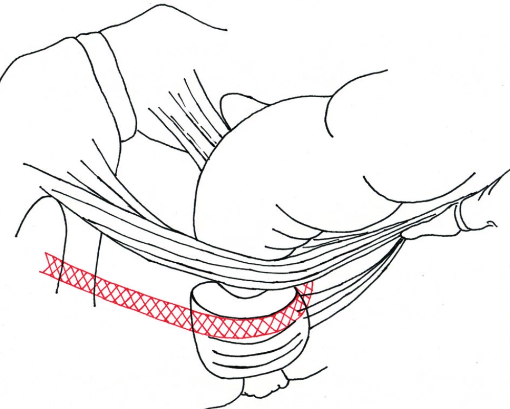 Schéma umístění pásky – bočný pohled
Fig 2: Outline of position of a anal sling – lateral view