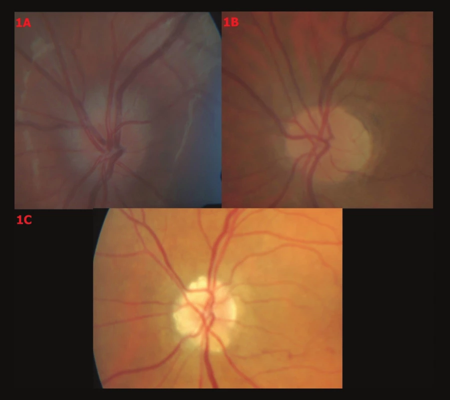 Barevné fotografické snímky papily optického nervu s různými stupni drúz. 1A – Drúzy stupně 0, 1B – drúzy stupně I, 1C – drúzy stupně II