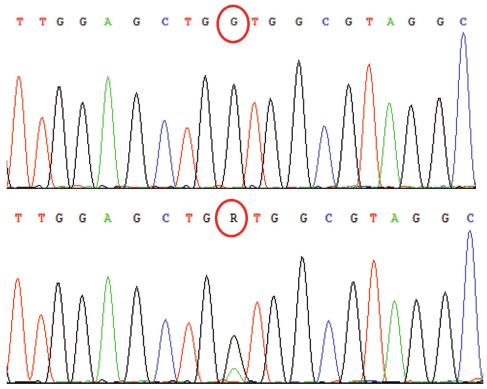 Sekvenogram s analýzou genu K-RAS (nahoře: referenční „wild type“ sekvence, dole: analyzovaná sekvence). Jde o somatickou mutaci se záměnou báze G na A. Mutantní pík (A) je snížený pravděpodobně v důsledku přiítomnosti nenádorové komponenty v izolovaném materiálu. Mutace byla potvrzena druhou nezávislou metodou.