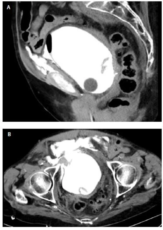 A, B CT cystografie
s velkou náplní, sagitální řez
(3A) a axiální (3B) je patrný extraperitoneální
únik kontrastní
látky<br>
Fig. 3. A, B CT cystography
on further filling of the bladder,
sagittal (3A) and axial (3B)
view extraperitoneal leakage
of contrast is demonstrated