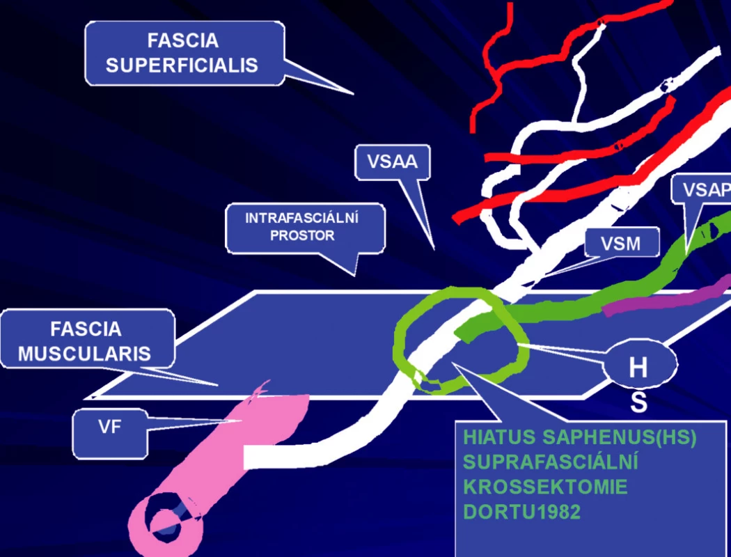 Safénový komplex typ I – VSM a z nich odstupující VSAA pod fascia muscularis, VSAP odstupuje až v HS, VSAA má nad fascia muscularis samostatný průběh mimo HS