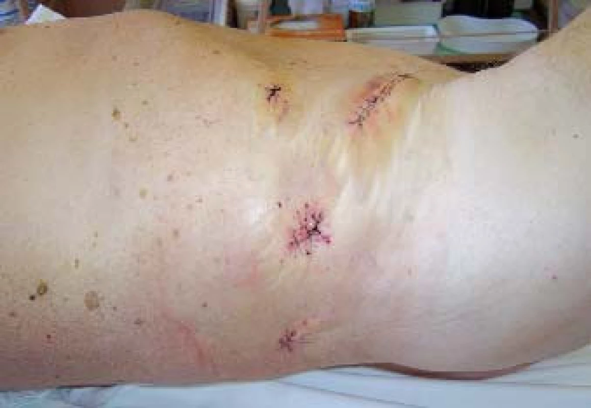 Fotografie břicha pacienta po retroperitoneoskopické nefrektomii. Extrakce preparátu byla provedena rozšířením původního portu 12 mm na střídavý řez.