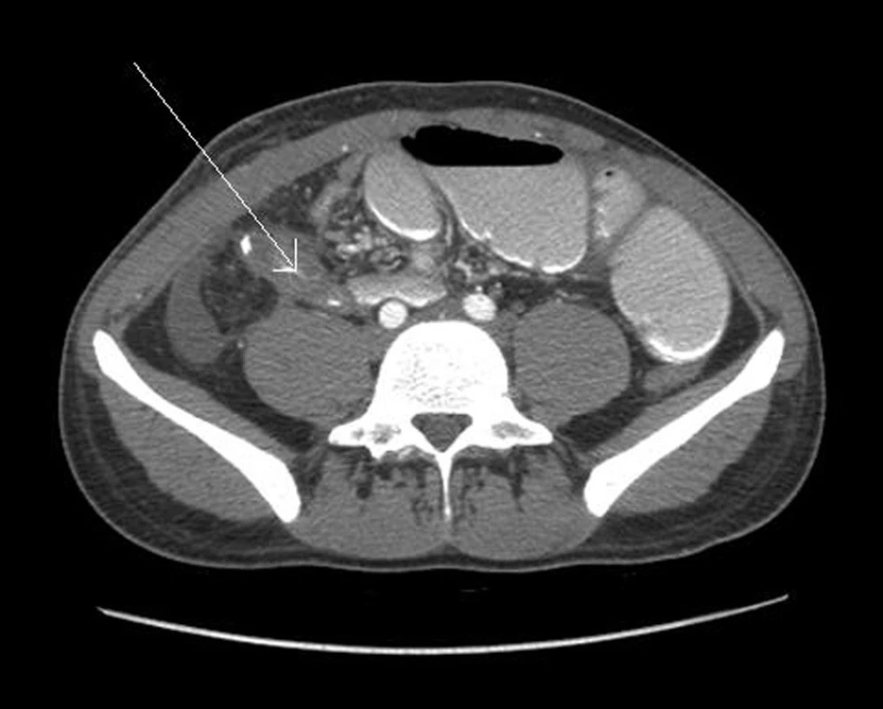 Kontrolní CT sken 9. pooperační den prokazující nádorové masy v oblasti ileotransverzoanastomózy
Fig. 2: Control CT scan on the ninth postoperative day showed tumor masses in the area of the ileo-colic anastomosis