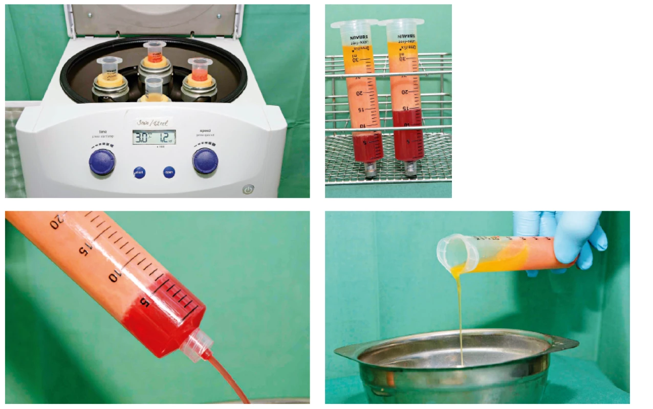 Fat processing by centrifugation in 30-ml syringes for high-volume fat grafting