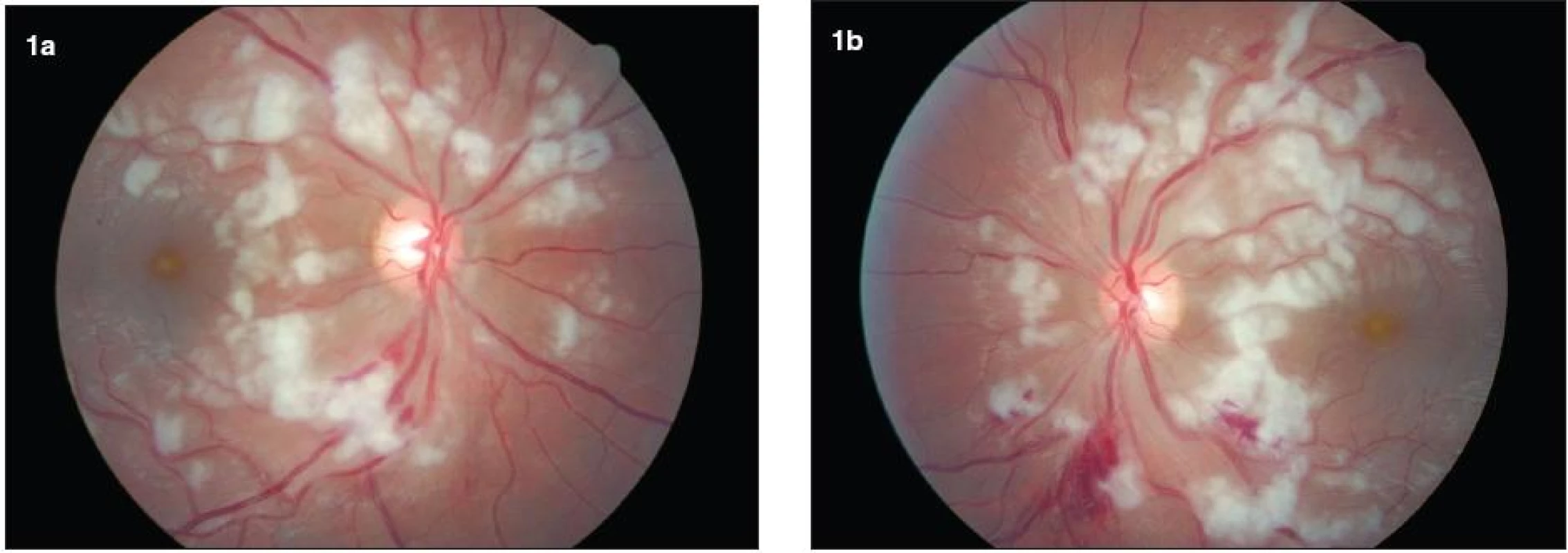Farebná fotografia fundu obidvoch očí. a, b) Bilaterálne vidno mnohopočetné belavé vatovité ložiská miestami až splývajúce, nachádzajúce sa najmä peripapilárne. Intraretinálne krvácania sú prítomné na obidvoch očiach, výraznejšie vľavo. Terč zrakového nervu je bez opuchu