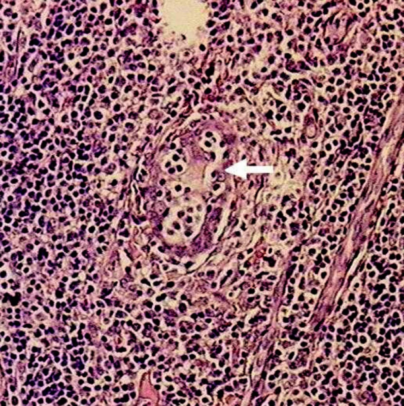 Histologický nález potvrdzujúci diagnózu Sjögrenovho syndrómu: tkanivo kryté masívnymi lymfocytárnymi infiltrátmi, deštrukcia malých slinných žliaz, šípka naznačuje deštruovaný vývod (hematoxylín-eozín, 100x zväčšené).