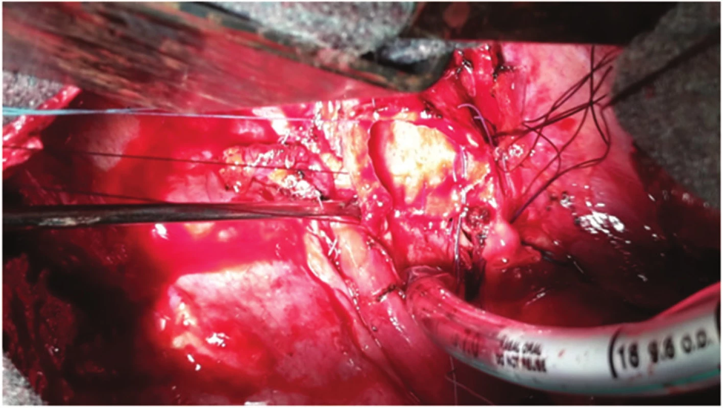 Selektivní intubace z operačního pole, stav po resekci kariny
Fig. 4: Selective intubation from the operation field; status after resection of carina