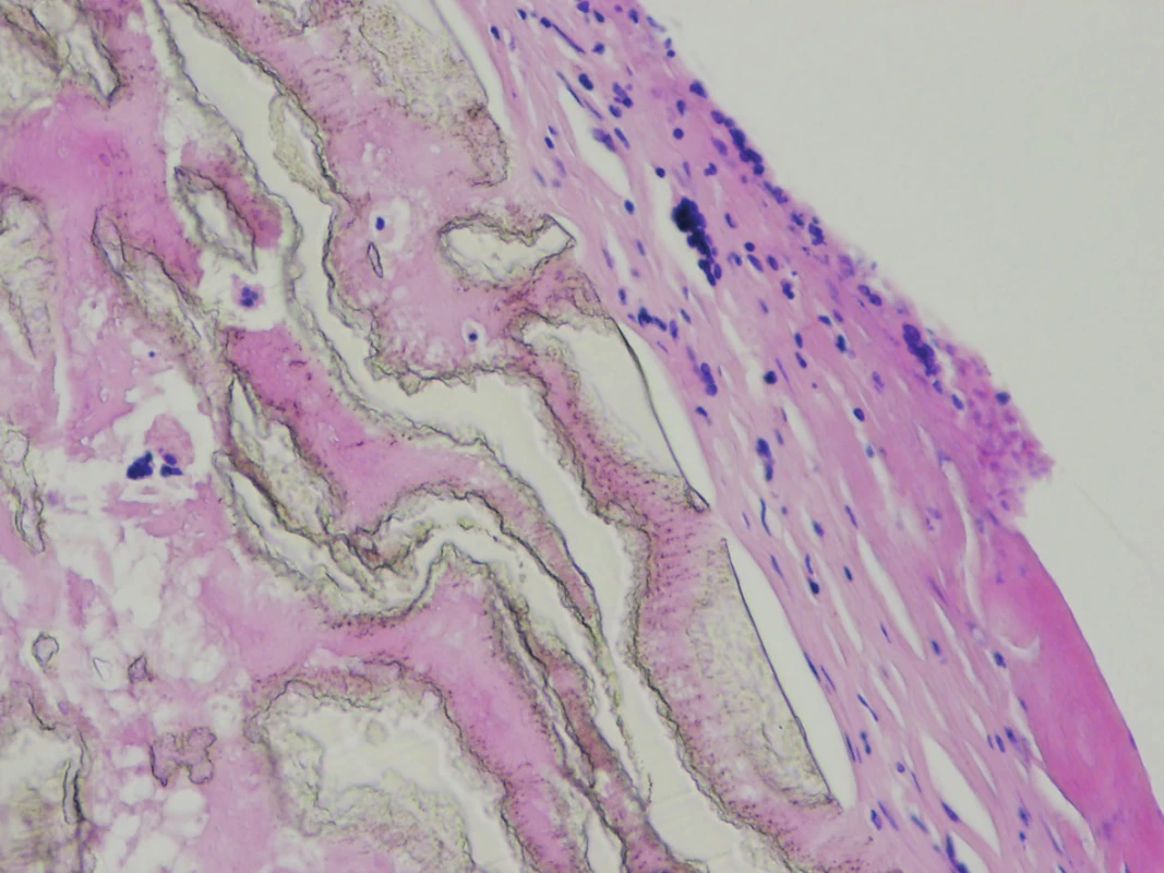 The surface of the vascular graft, fibrous membrane infiltrated by lympho-plasmocytic inflammatory infiltration